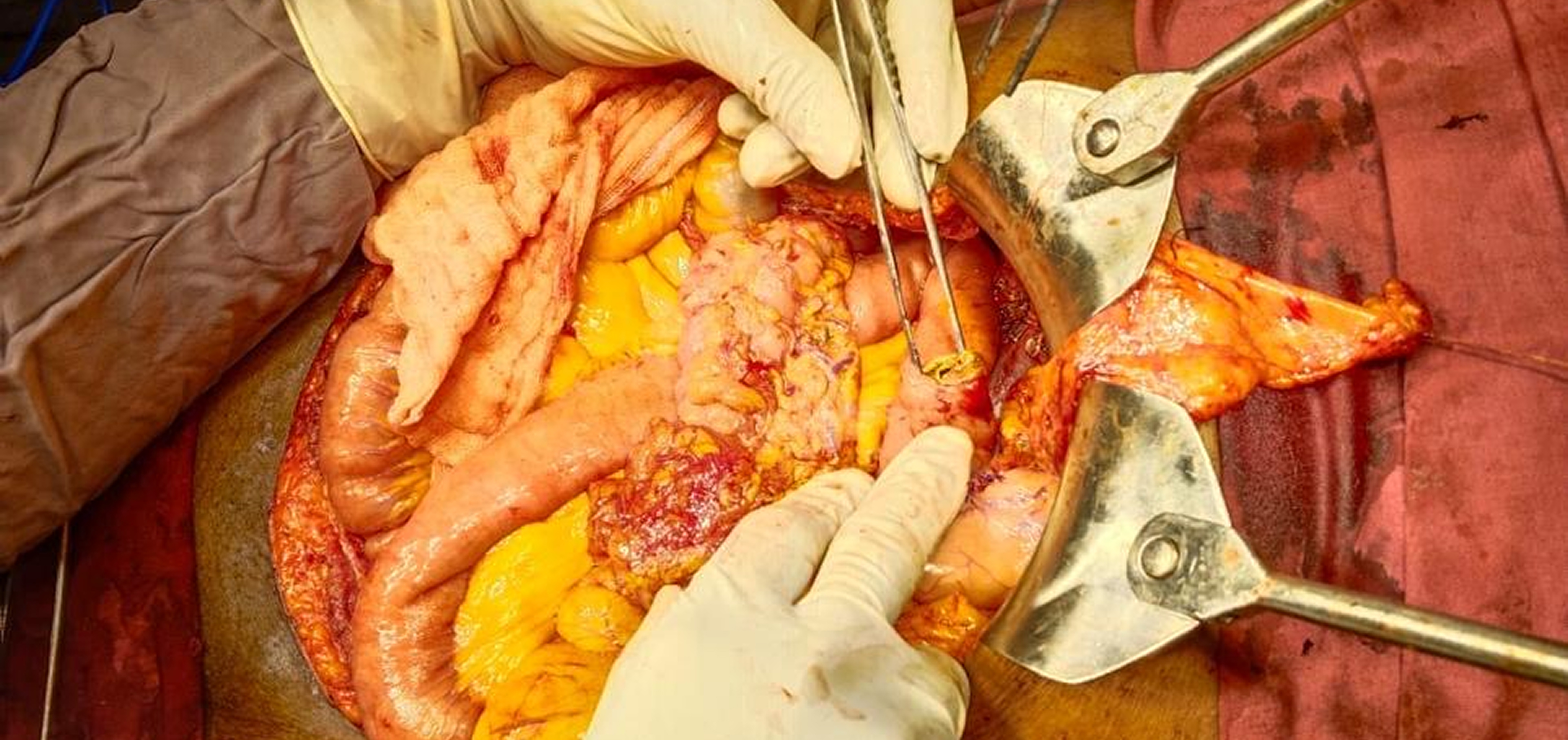 Redefining Cancer Care in Nizamabad