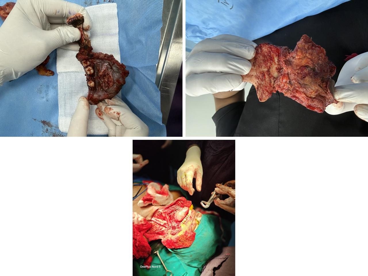 Composite surgical photographs from an oral cancer resection