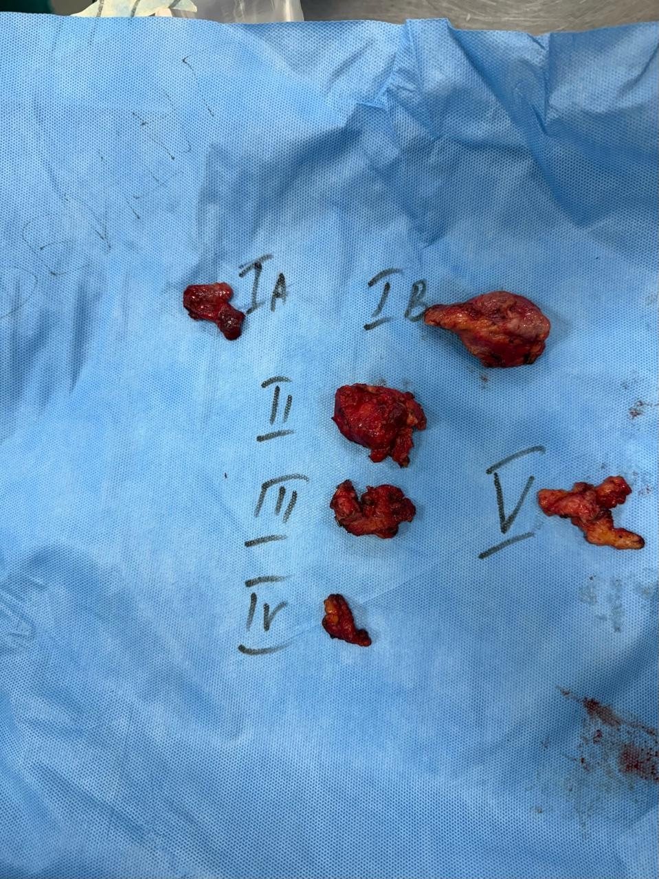 Neck dissection specimen arranged and labelled by nodal level